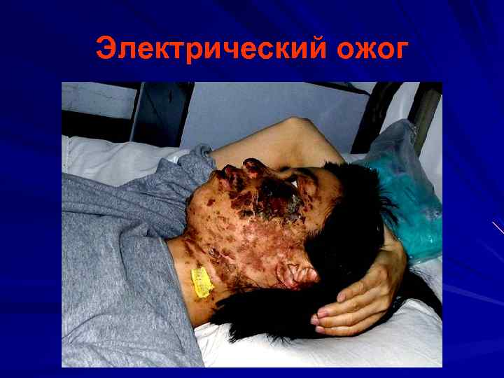 Электрический ожог 