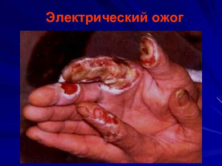 Электрический ожог 