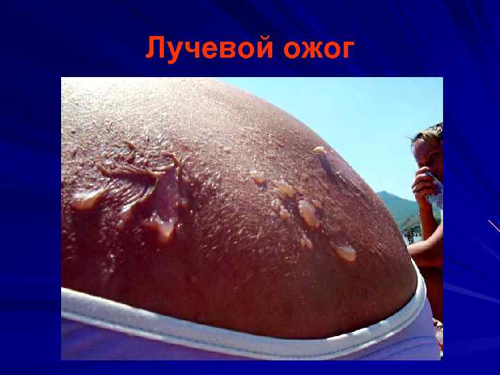 Лучевой ожог 