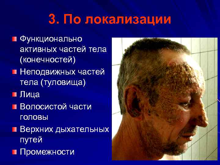 3. По локализации Функционально активных частей тела (конечностей) Неподвижных частей тела (туловища) Лица Волосистой