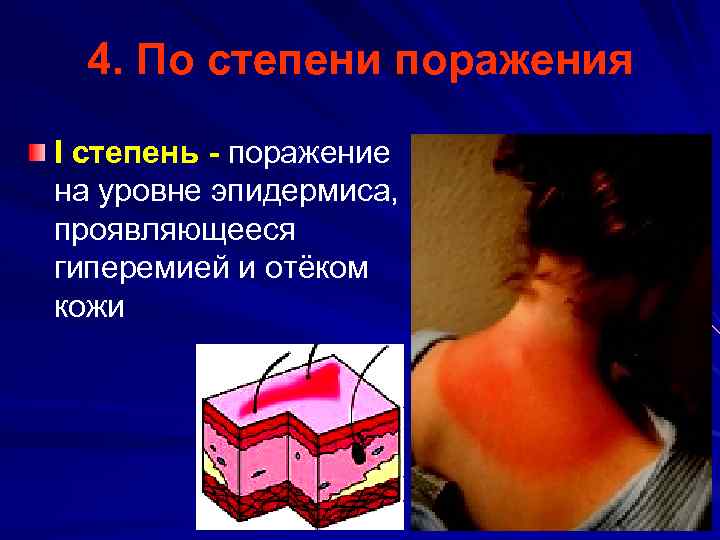4. По степени поражения I степень - поражение на уровне эпидермиса, проявляющееся гиперемией и