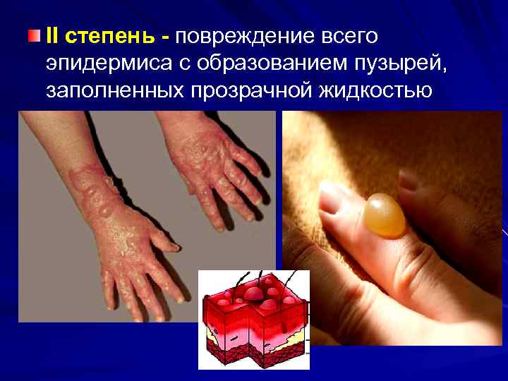 II степень - повреждение всего эпидермиса с образованием пузырей, заполненных прозрачной жидкостью 