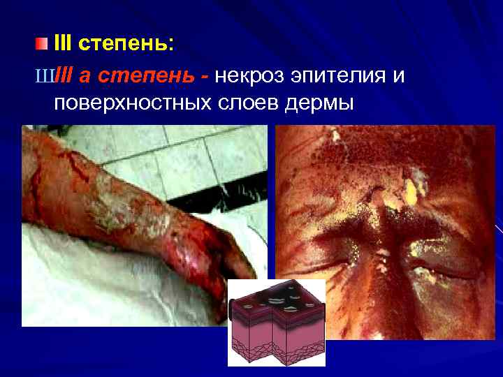 III степень: ШIII a степень - некроз эпителия и поверхностных слоев дермы 