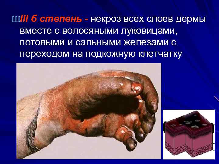 ШIII б степень - некроз всех слоев дермы вместе с волосяными луковицами, потовыми и