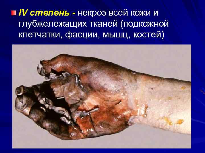 IV степень - некроз всей кожи и глубжележащих тканей (подкожной клетчатки, фасции, мышц, костей)