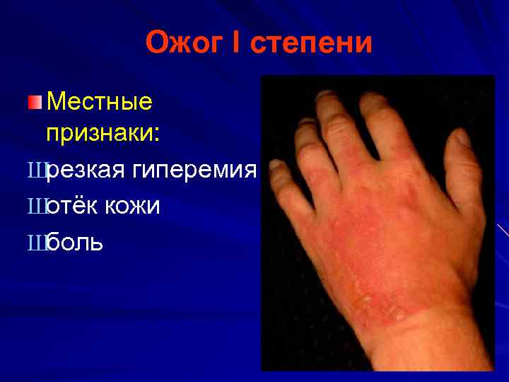 Ожог I степени Местные признаки: Шрезкая гиперемия Шотёк кожи Шболь 