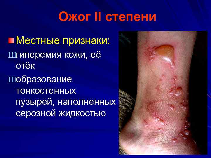 Ожог II степени Местные признаки: Шгиперемия кожи, её отёк Шобразование тонкостенных пузырей, наполненных серозной