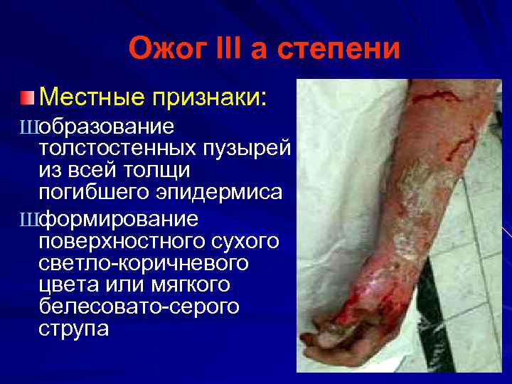 Ожог III a степени Местные признаки: Шобразование толстостенных пузырей из всей толщи погибшего эпидермиса