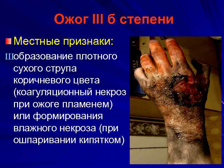 Ожог III б степени Местные признаки: Шобразование плотного сухого струпа коричневого цвета (коагуляционный некроз