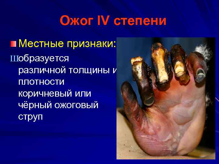 Ожог IV степени Местные признаки: Шобразуется различной толщины и плотности коричневый или чёрный ожоговый