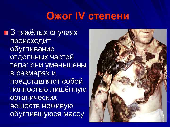 Ожог IV степени В тяжёлых случаях происходит обугливание отдельных частей тела: они уменьшены в