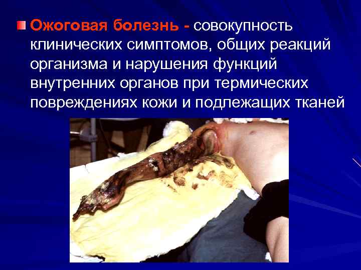 Ожоговая болезнь - совокупность клинических симптомов, общих реакций организма и нарушения функций внутренних органов