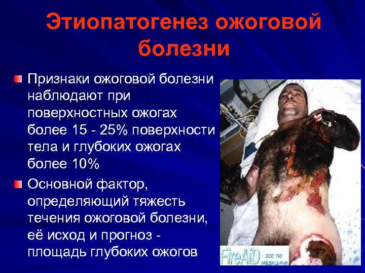 Этиопатогенез ожоговой болезни Признаки ожоговой болезни наблюдают при поверхностных ожогах более 15 - 25%