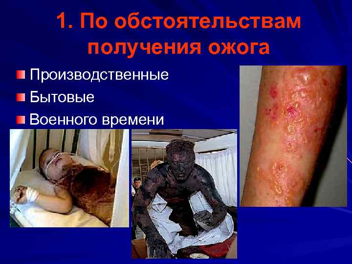 1. По обстоятельствам получения ожога Производственные Бытовые Военного времени 