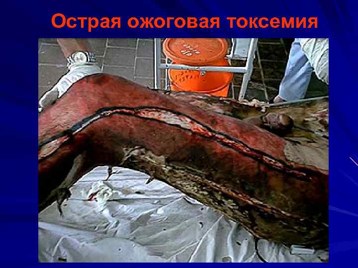 Острая ожоговая токсемия 