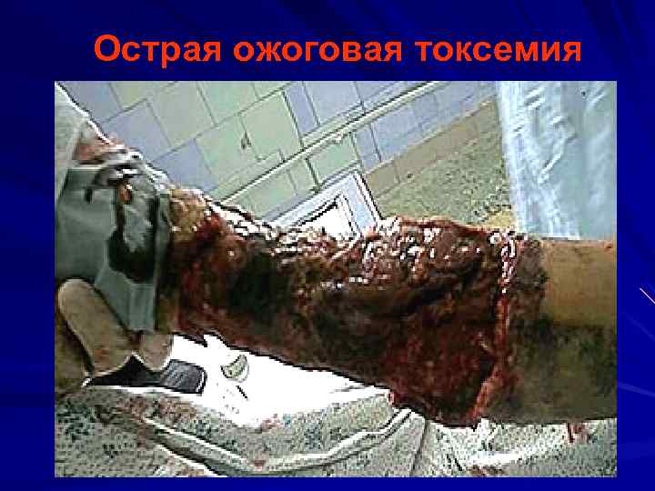 Острая ожоговая токсемия 