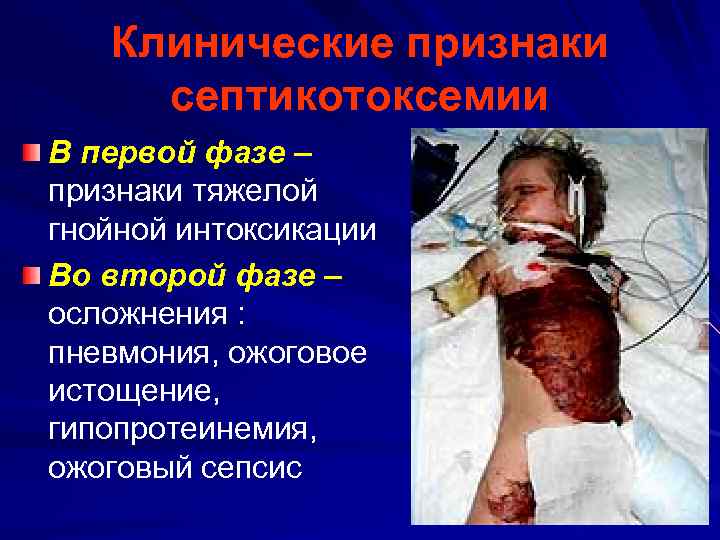 Клинические признаки септикотоксемии В первой фазе – признаки тяжелой гнойной интоксикации Во второй фазе