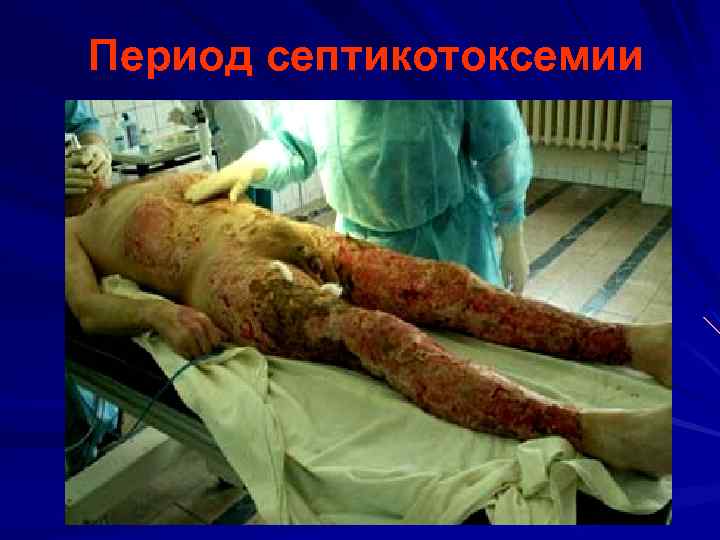 Период септикотоксемии 
