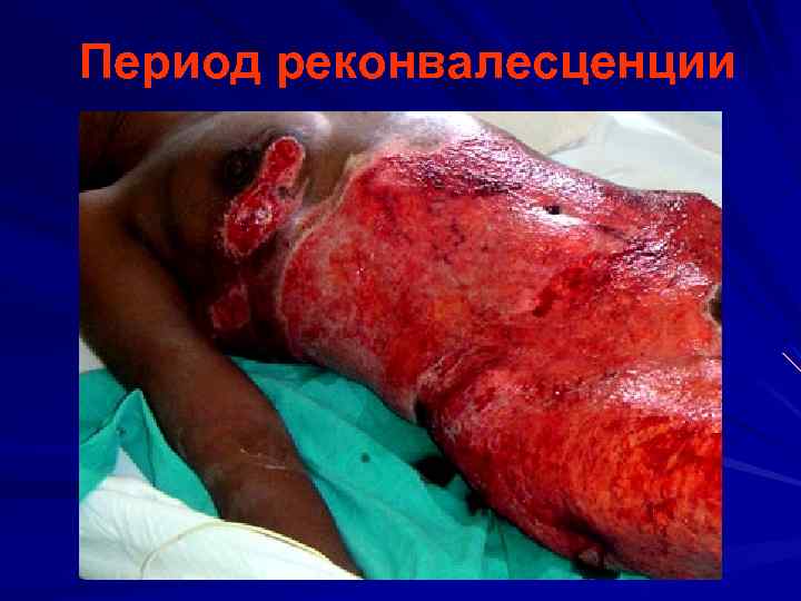 Период реконвалесценции 
