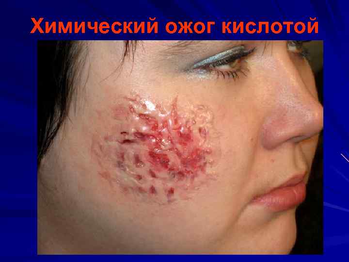 Химический ожог кислотой 