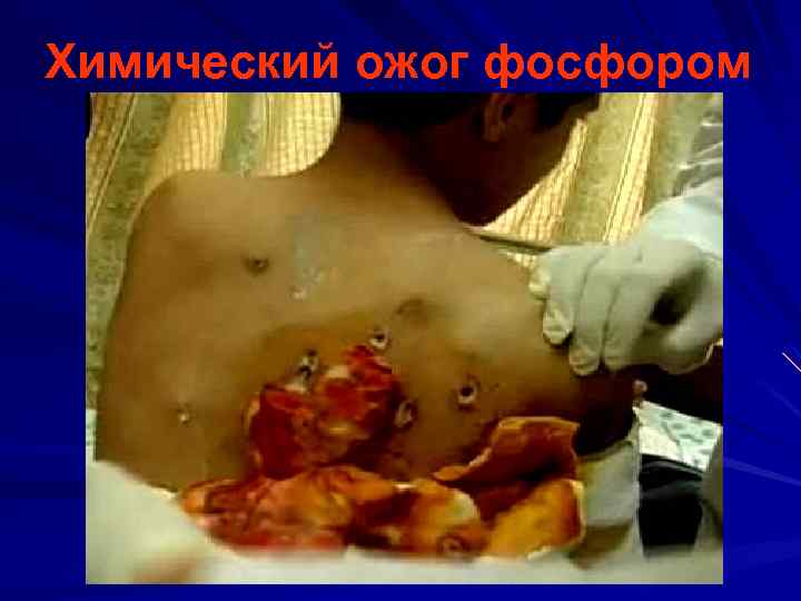 Химический ожог фосфором 