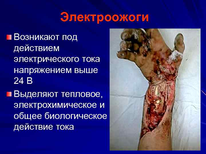Электроожоги Возникают под действием электрического тока напряжением выше 24 В Выделяют тепловое, электрохимическое и