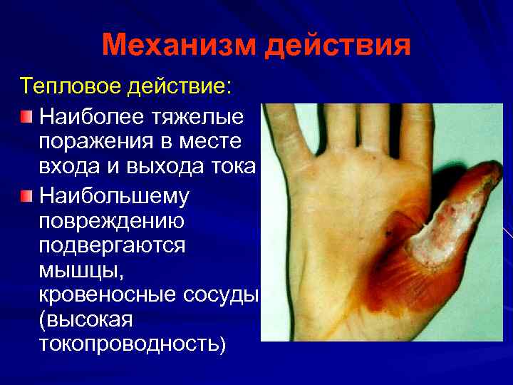 Механизм действия Тепловое действие: Наиболее тяжелые поражения в месте входа и выхода тока Наибольшему