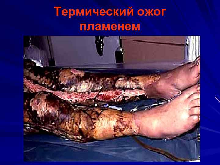 Термический ожог пламенем 