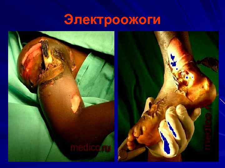 Электроожоги 