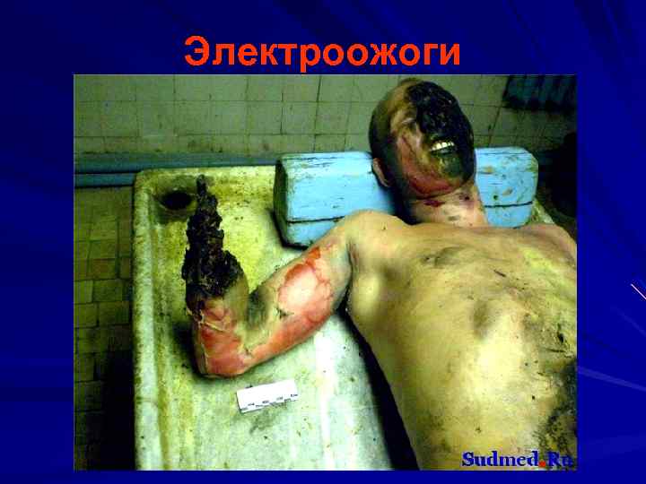 Электроожоги 