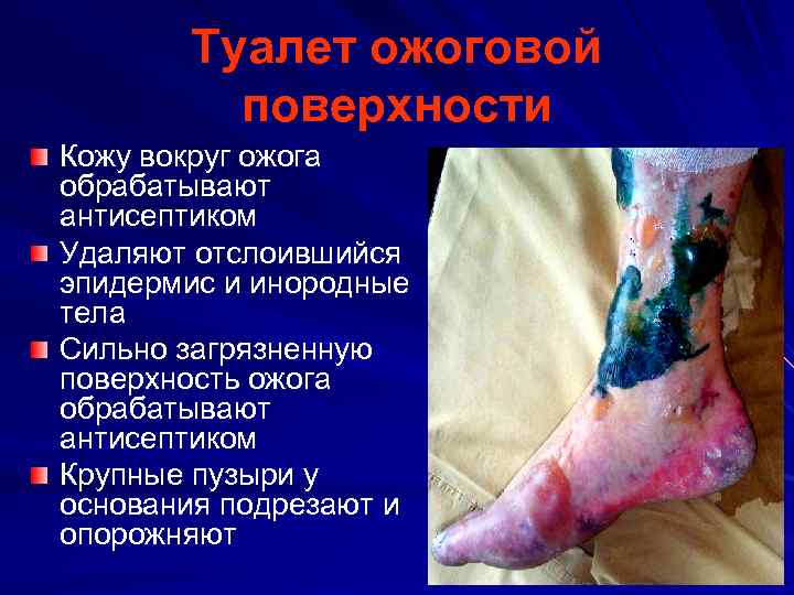 Туалет ожоговой поверхности Кожу вокруг ожога обрабатывают антисептиком Удаляют отслоившийся эпидермис и инородные тела