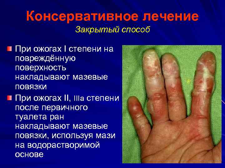 Консервативное лечение Закрытый способ При ожогах I степени на повреждённую поверхность накладывают мазевые повязки