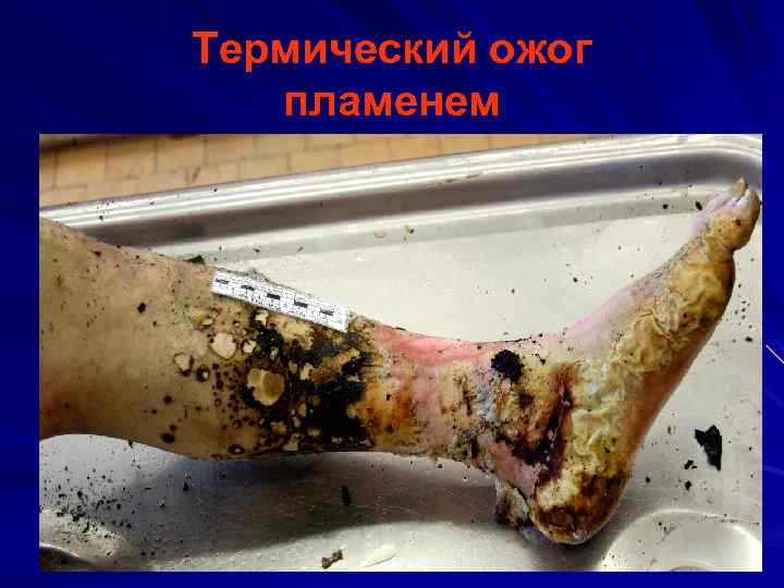 Термический ожог пламенем 