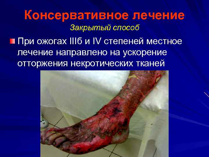 Консервативное лечение Закрытый способ При ожогах IIIб и IV степеней местное лечение направлено на