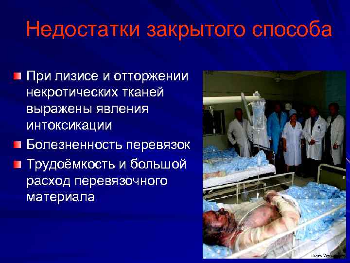 Недостатки закрытого способа При лизисе и отторжении некротических тканей выражены явления интоксикации Болезненность перевязок