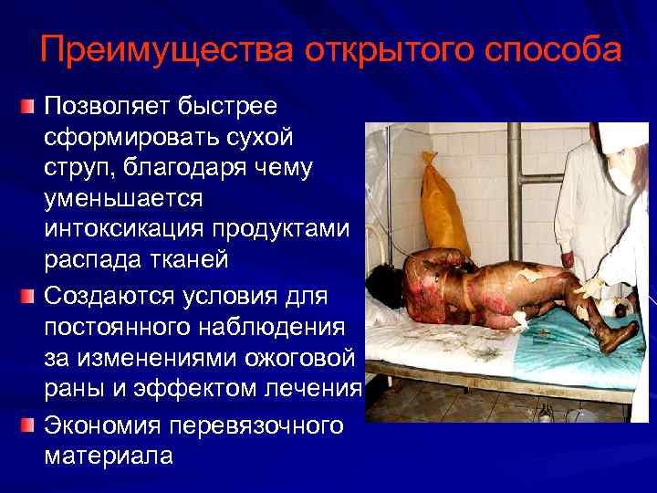 Преимущества открытого способа Позволяет быстрее сформировать сухой струп, благодаря чему уменьшается интоксикация продуктами распада