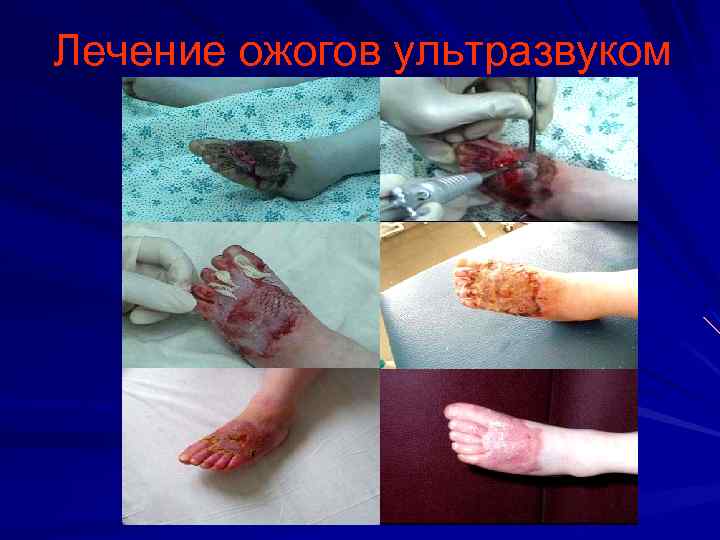 Лечение ожогов ультразвуком 