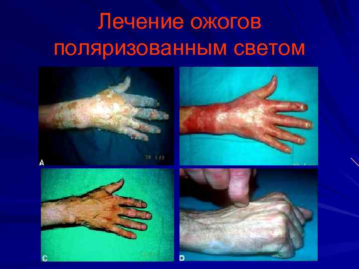Лечение ожогов поляризованным светом 
