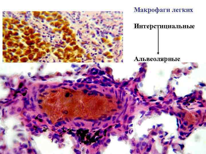 Альвеолярные макрофаги в мокроте фото