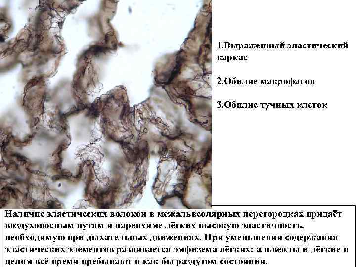 1. Выраженный эластический каркас 2. Обилие макрофагов 3. Обилие тучных клеток Наличие эластических волокон