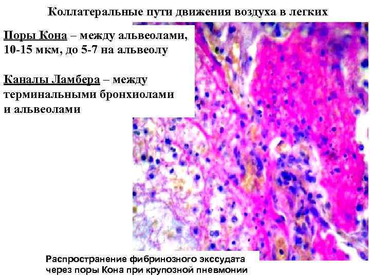 Коллатеральные пути движения воздуха в легких Поры Кона – между альвеолами, 10 -15 мкм,