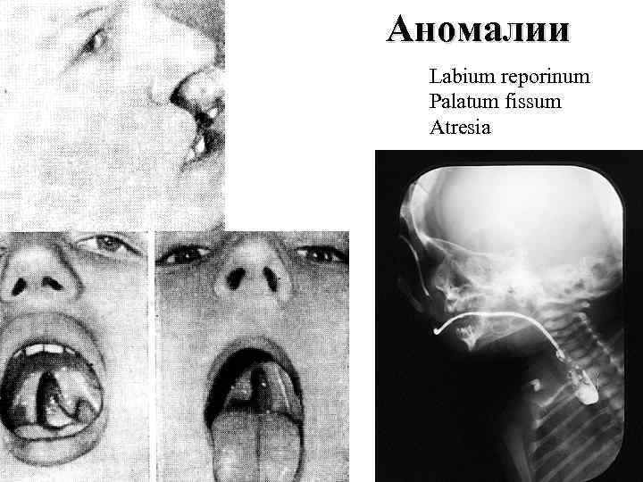 Аномалии Labium reporinum Palatum fissum Atresia 