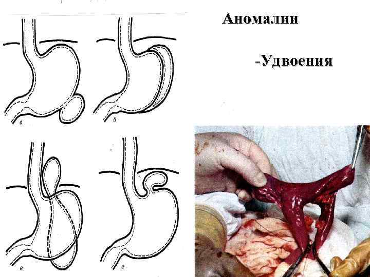 Аномалии -Удвоения 