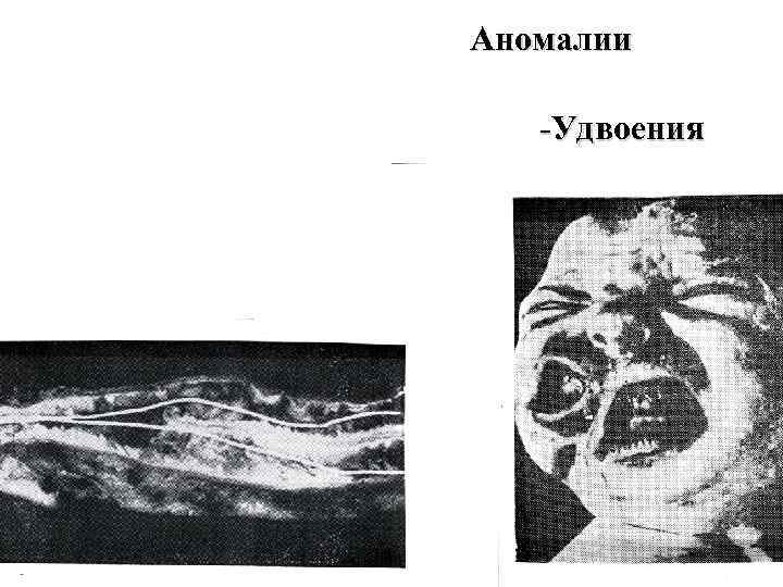 Аномалии -Удвоения 