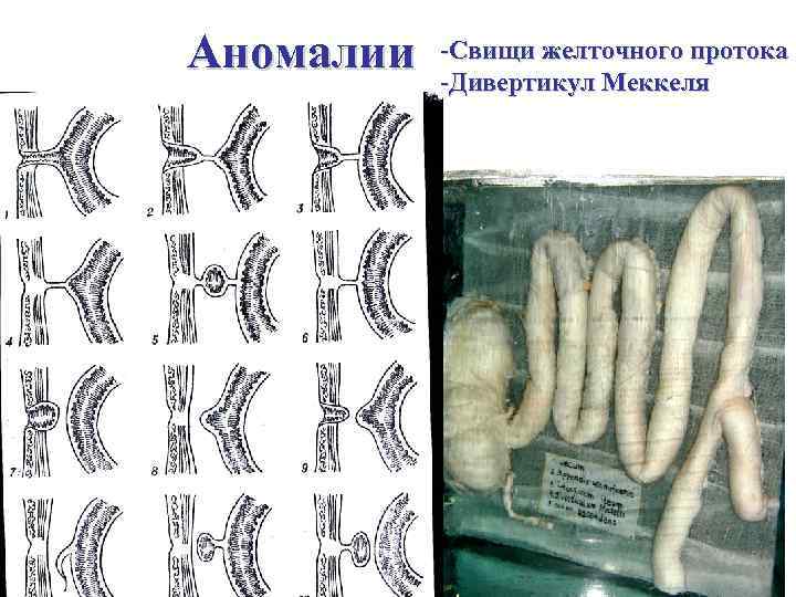 Аномалии -Свищи желточного протока -Дивертикул Меккеля 
