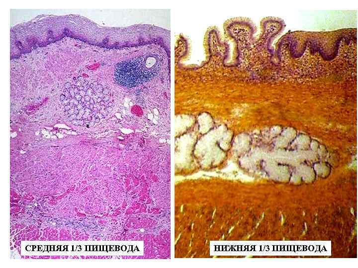 СРЕДНЯЯ 1/3 ПИЩЕВОДА НИЖНЯЯ 1/3 ПИЩЕВОДА 