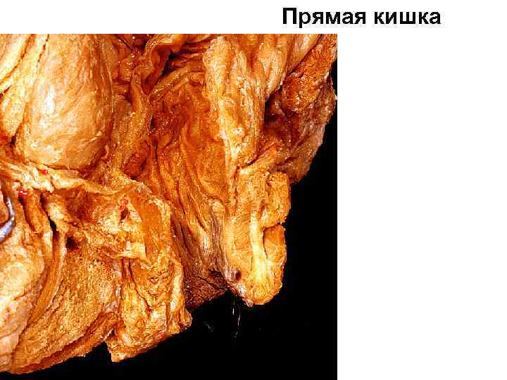 Прямая кишка 