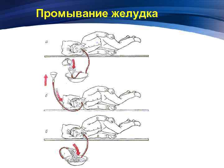 Промывание желудка без сознания. Промывание желудка схема. Промывание желудка у детей алгоритм.