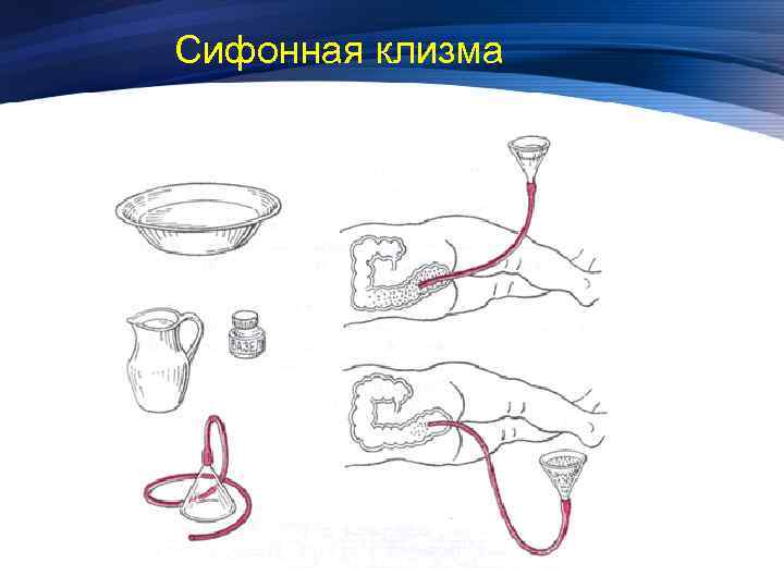 Сифонная клизма картинки