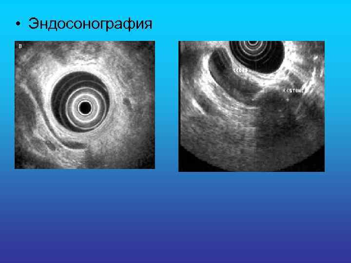  • Эндосонография 